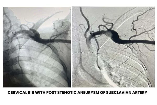 Cervical rib with post stenotic aneurysm of subclavian artery