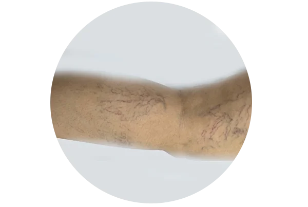 Varicose Veins