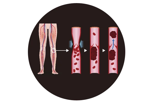 Deep Vein Thrombosis