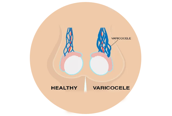 Varicocele