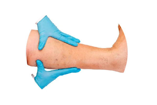 Peripheral Artery Disease