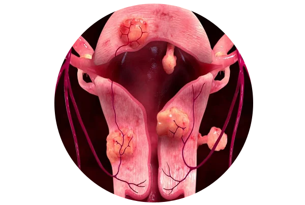 Uterine Fibroid Embolization
