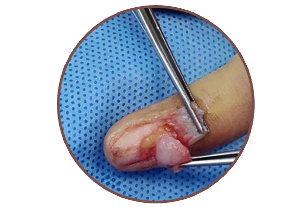 Glomus Tumour Treatment