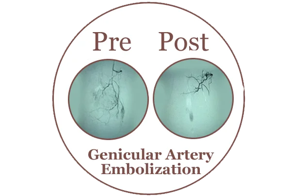Genicular Artery Embolization