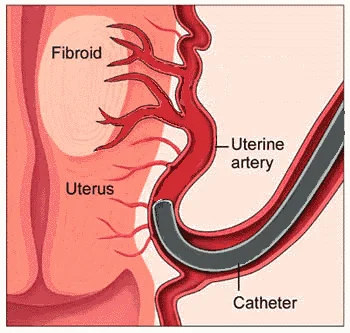 Treatment of Uterine Fibroid Without Surgery