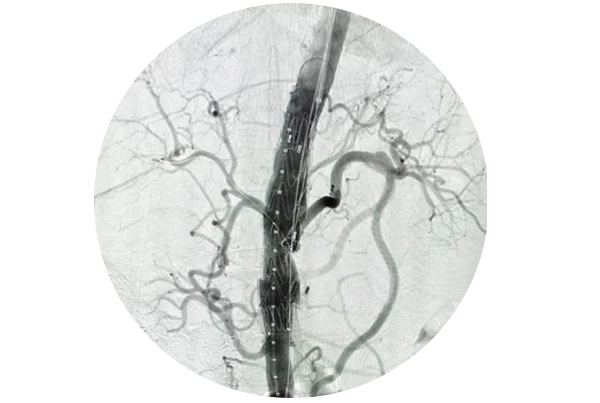 Endovascular Surgery
