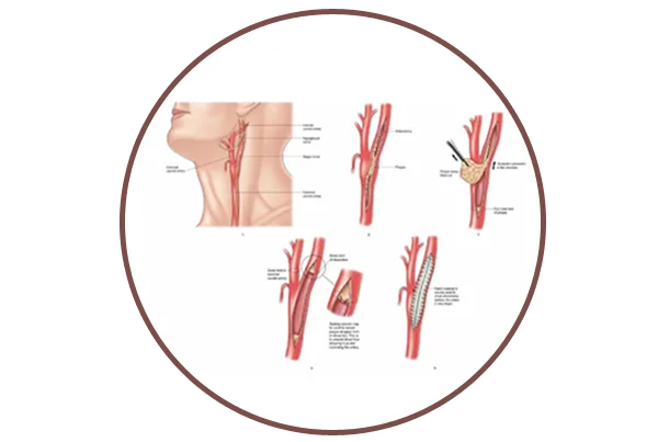 Carotid Surgery